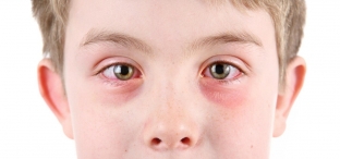 osnovnye-formy-i-simptomy-allergicheskogo-kon-yunktivita