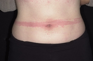 osnovnye-simptomy-mastotsitoza-v-zavisimosti-ot-ego-formy