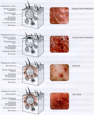 osnovy-patogeneticheskogo-lecheniya-vulgarnykh-ugrej