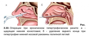 osobennosti-khirurgicheskogo-lecheniya-gipertroficheskogo-rinita