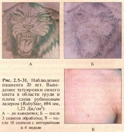 osobennosti-udaleniya-tatuirovok-s-pomoshchyu-lazera