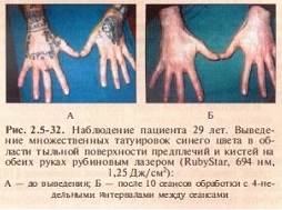 osobennosti-udaleniya-tatuirovok-s-pomoshchyu-lazera