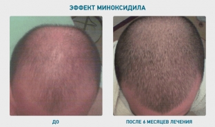 ot-yazvy-zheludka-do-alopetsii-osobennosti-primeneniya-minoksidila