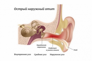 otity-plovtsov-kak-ne-prevratit-dolgozhdannyj-otdykh-v-lechenie
