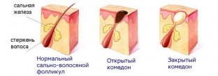 otkrytye-i-zakrytye-komedony-bazovaya-informatsiya-dlya-spetsialistov