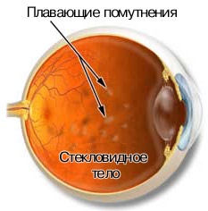 otkuda-berutsya-mushki-pered-glazami