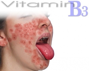 pellagra-kogda-defitsit-vitaminov-mozhet-stoit-zhizni