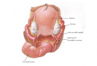 pelvioperitonit-i-parametrit-groznye-oslozhneniya-v-ginekologii
