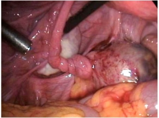 perekrut-nozhki-opukholi-yaichnika-srochno-diagnostirovat-i-raskrutit