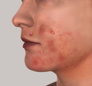 perioralnyj-dermatit-klinika-differentsialnyj-diagnoz-terapiya