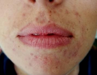 perioralnyj-dermatit-klinika-differentsialnyj-diagnoz-terapiya