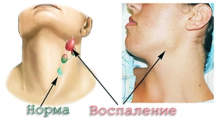 pervichnyj-sifilis-vnimanie-na-limfouzly