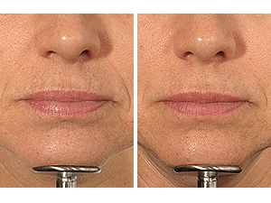 pervyj-odobrennyj-fda-autologichnyj-filler-dlya-korrektsii-nosogubnykh-skladok