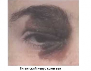 pigmentnye-nevusy-na-kozhe-vek-fiziologiya-ili-opasnost