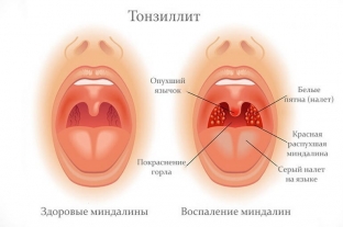 pochemu-bolit-gorlo-prichiny-i-lechenie