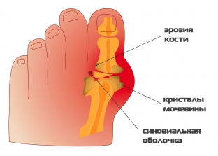 pochemu-bolyat-koleni-prichiny-i-sledstviya