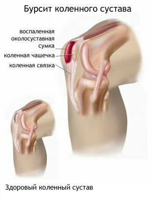 pochemu-bolyat-koleni-prichiny-i-sledstviya