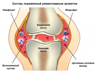 pochemu-bolyat-koleni-prichiny-i-sledstviya