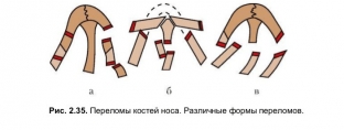 pochemu-ochki-i-stupenki-na-litse-mogut-byt-priznakom-travm-nosa