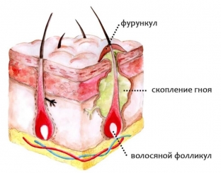 pochemu-poyavlyaetsya-furunkul-kozhi-i-kak-s-nim-borotsya