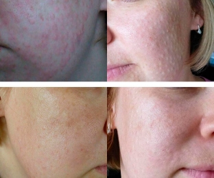 pochemu-poyavlyayutsya-i-kogda-ischezayut-papuly-posle-biorevitalizatsii