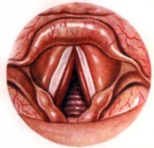 pochemu-razvivaetsya-lozhnyj-krup-simptomy-i-osobennosti-lozhnogo-krupa