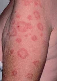 pochemu-vazhno-diagnostirovat-vospalitelnye-povrezhdeniya-kozhi-koltsevidnoj-formy