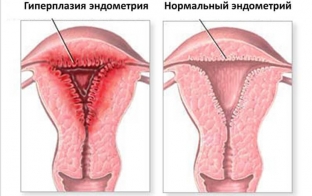 pochemu-voznikayut-disfunktsionalnye-matochnye-krovotecheniya