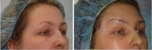 podtyazhka-litsa-i-shei-nityami-aptos-po-metodike-excellence-visage