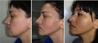 podtyazhka-litsa-i-shei-nityami-aptos-po-metodike-excellence-visage