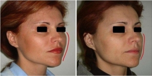 podtyazhka-litsa-i-shei-nityami-aptos-po-metodike-excellence-visage