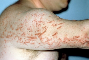 porazheniya-kozhi-pri-diabete-trebuyut-osobogo-podkhoda-k-lecheniyu