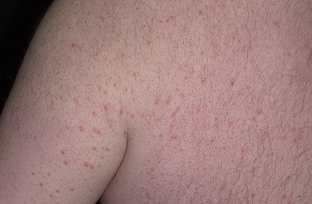 porazheniya-kozhi-pri-diabete-trebuyut-osobogo-podkhoda-k-lecheniyu