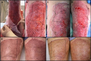 posleoperatsionnyj-ukhod-dlya-profilaktiki-ottorzheniya-transplantata