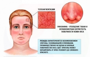 pravilnoe-kosmetologicheskoe-vedenie-patsientov-s-rozatsea-na-litse