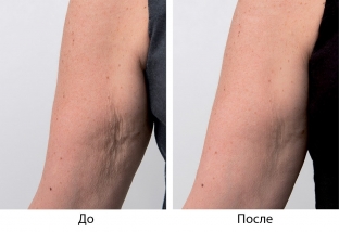 preparat-viscoderm---vybor-professionalov-dlya-biorestrukturizatsii-kozhi