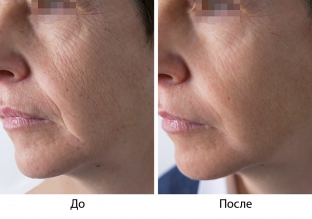 preparat-viscoderm---vybor-professionalov-dlya-biorestrukturizatsii-kozhi