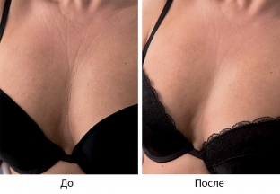 preparat-viscoderm---vybor-professionalov-dlya-biorestrukturizatsii-kozhi