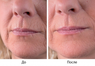 preparat-viscoderm---vybor-professionalov-dlya-biorestrukturizatsii-kozhi
