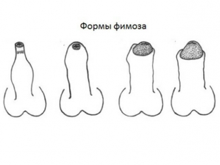prichiny-formirovaniya-i-simptomy-fimoza-u-malchikov