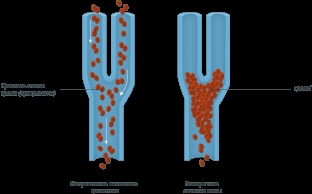 prichiny-i-simptomy-tromboza-sovremennoe-lechenie-tromboza-glubokikh-ven
