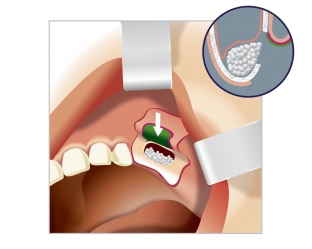 primenenie-endoskopii-vo-vremya-operatsii-sinus-lifting