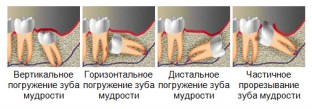 problemy-kotorye-svyazany-s-zubom-mudrosti