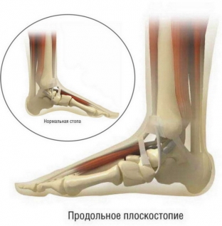 profilaktika-i-lechenie-ploskostopiya-chem-ranshe-tem-luchshe