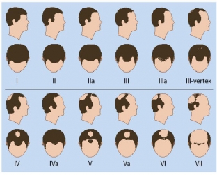 prp-dlya-volos-vozmozhnosti-obogashchennoj-trombotsitami-plazmy-v-lechenii-androgennoj-alopetsii