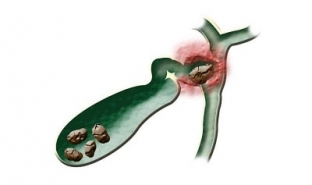 raspoznat-opasnost-simptomy-zhelchnokamennoj-bolezni
