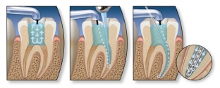 razrabotan-novyj-metod-lecheniya-khronicheskogo-periodontita-zubov