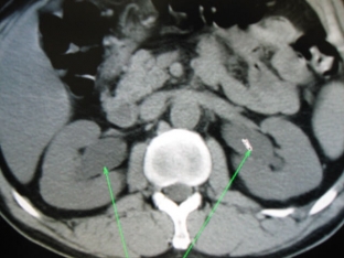 redkie-diagnozy-v-urologii-bolezn-ormonda