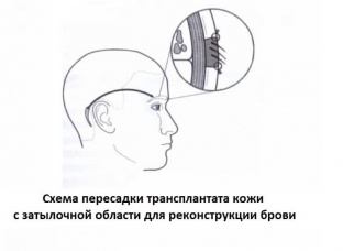 rekonstruktsiya-brovej-chto-mozhet-predlozhit-sovremennaya-khirurgiya