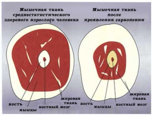 sarkopeniya-kak-ostanovit-poteryu-myshechnoj-massy
